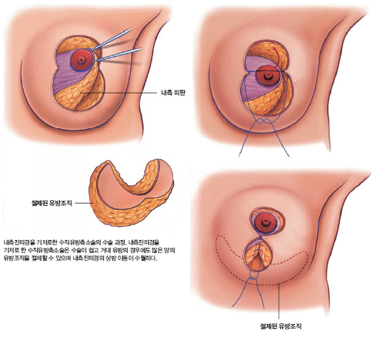 윤을식교수님 칼럼 유방비대증 figure1