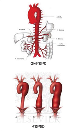 파열 대동맥 대동맥파열 대동맥박리
