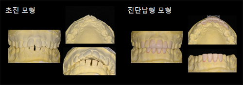 ÃÊÁø¸ðÇü°ú Áø´Ü³³Çü ¸ðÇü Á¦ÀÛ »çÁø