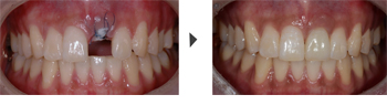 ¾Õ´Ï ÀÓÇöõÆ® Before vs After »çÁø
