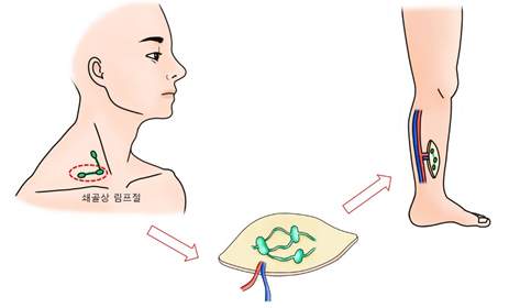 쇄골상 림프절 전이술의 과정