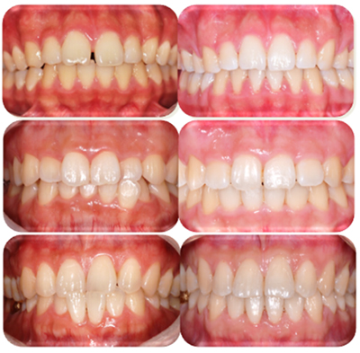 Ä¡¾Æ ±³Á¤ Áõ·Ê : Before & After »çÁø