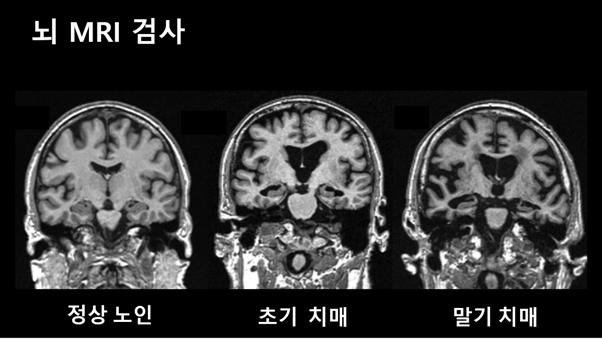 [창원 상남동 신병원] 혈관성 치매, 인지기능 저하 창원뇌MRI <창원신경과추천, 마산신경과추천, 진해신경과추천>