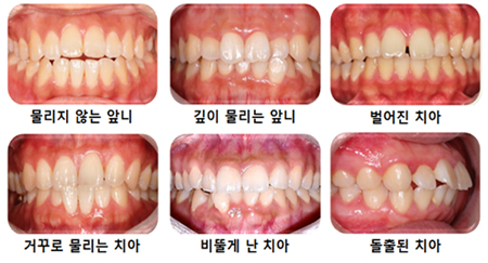 치아교정 시기별로 다양한 형태의 치아 부정교합을 알아보자